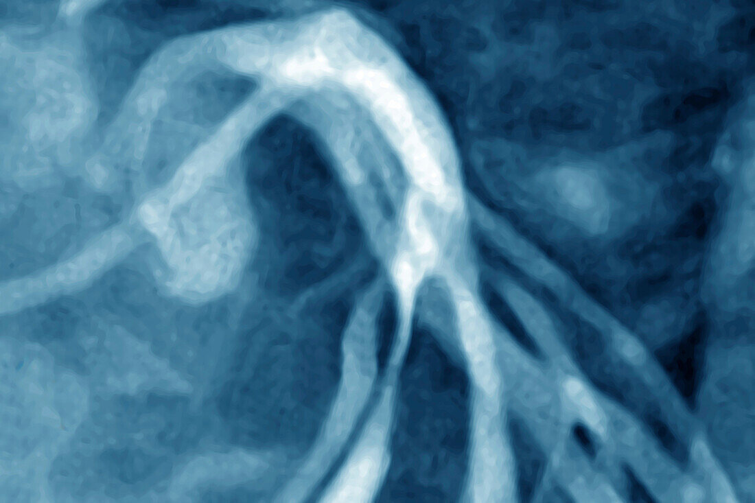 Angina pectoris, angiography