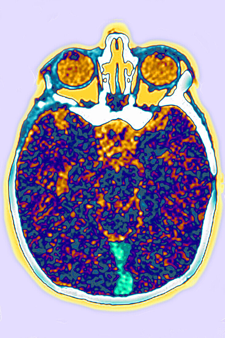 Cerebral venous thrombosis, CT scan