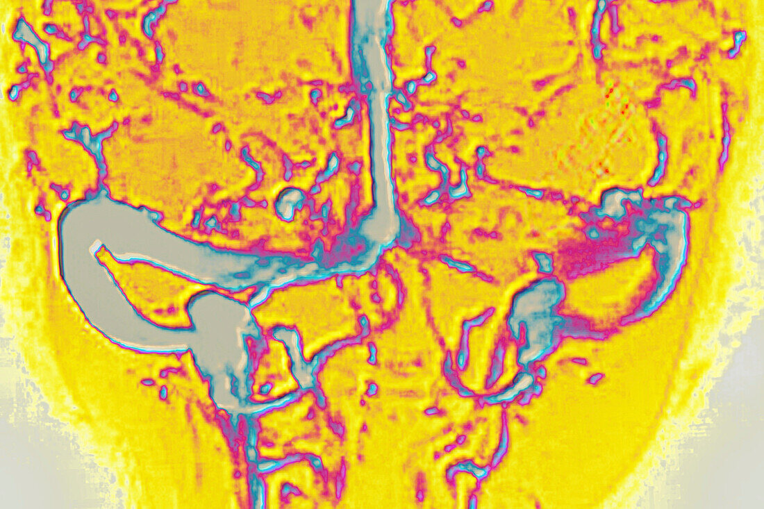 Cerebral venous thrombosis, angiography