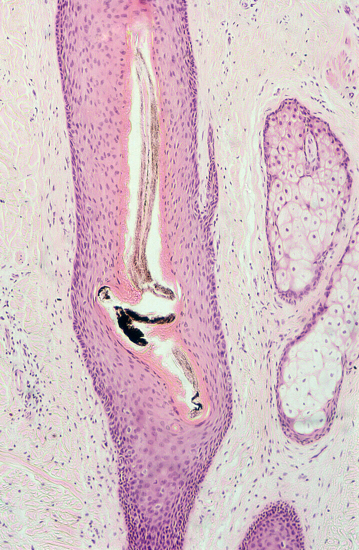 Damaged hair follicle, light micrograph