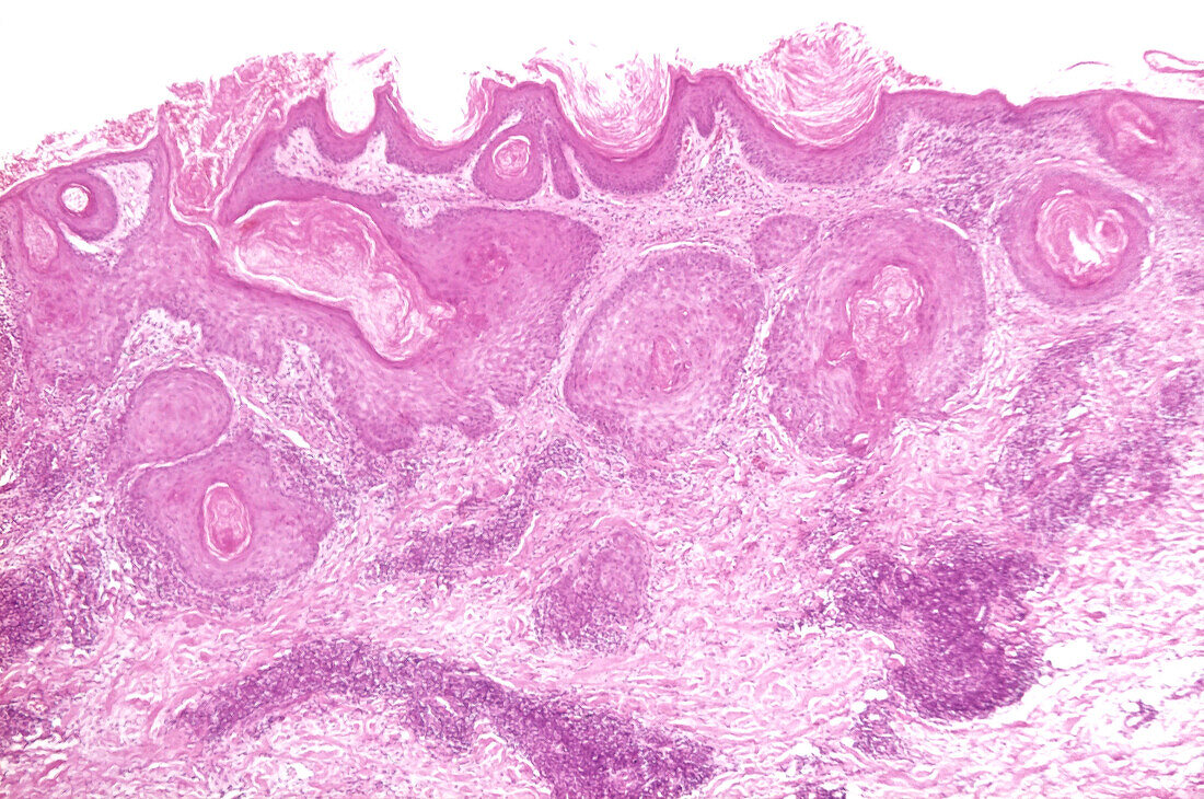 Chronic discoid lupus erythematosus, light micrograph