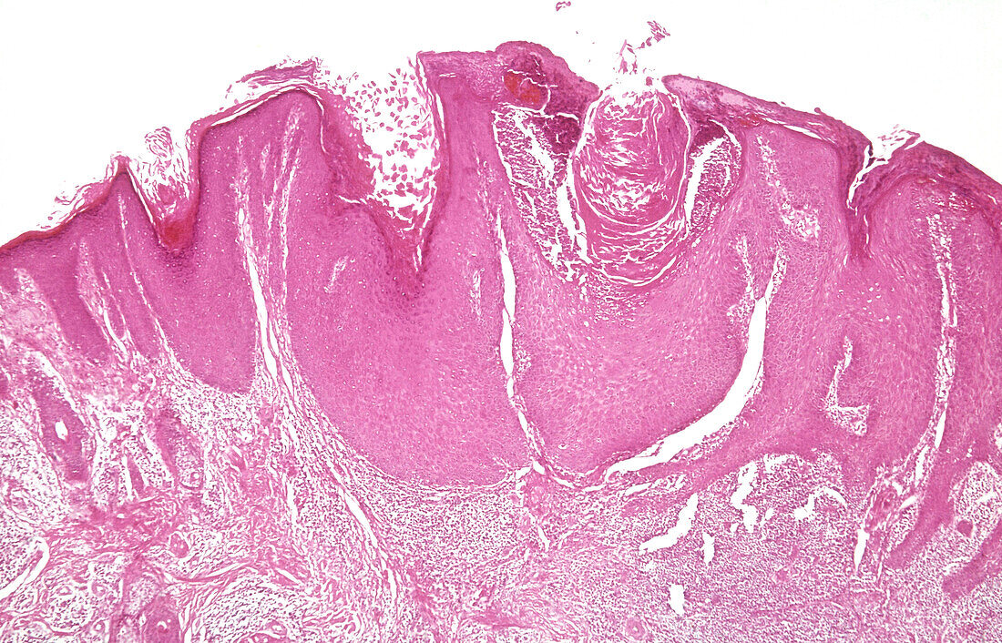 Prurigo nodularis, light micrograph