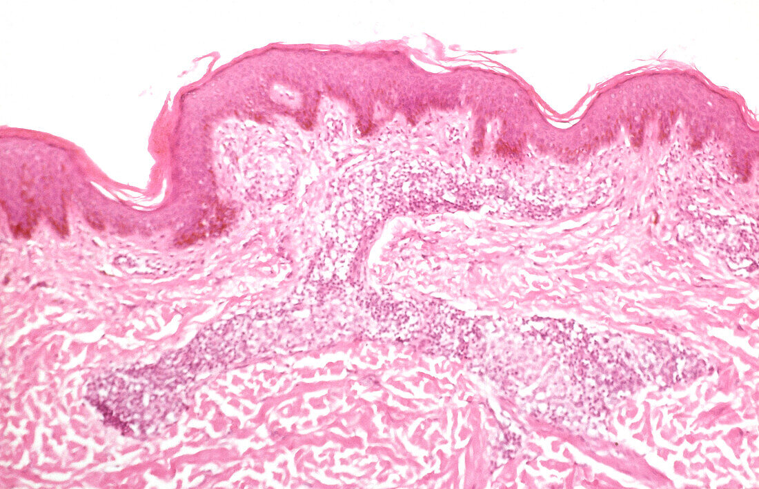 Leprosy, tuberculoid pattern, light micrograph