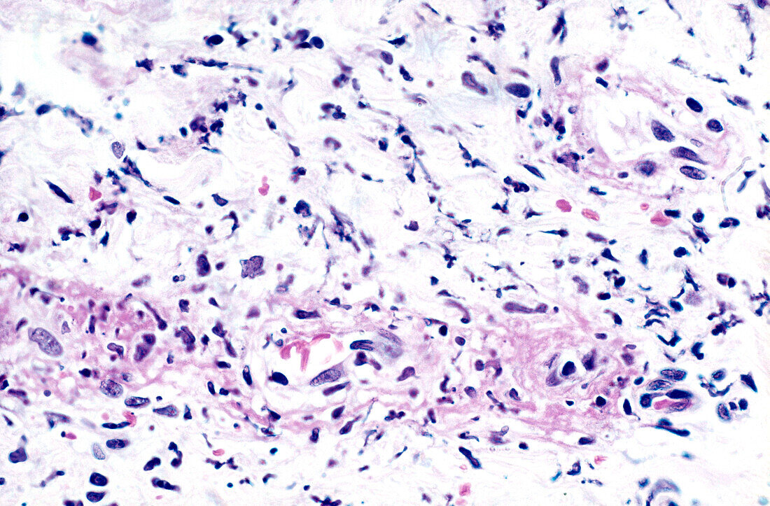 Acute neutrophilic (leucocytoclastic)., light micrograph