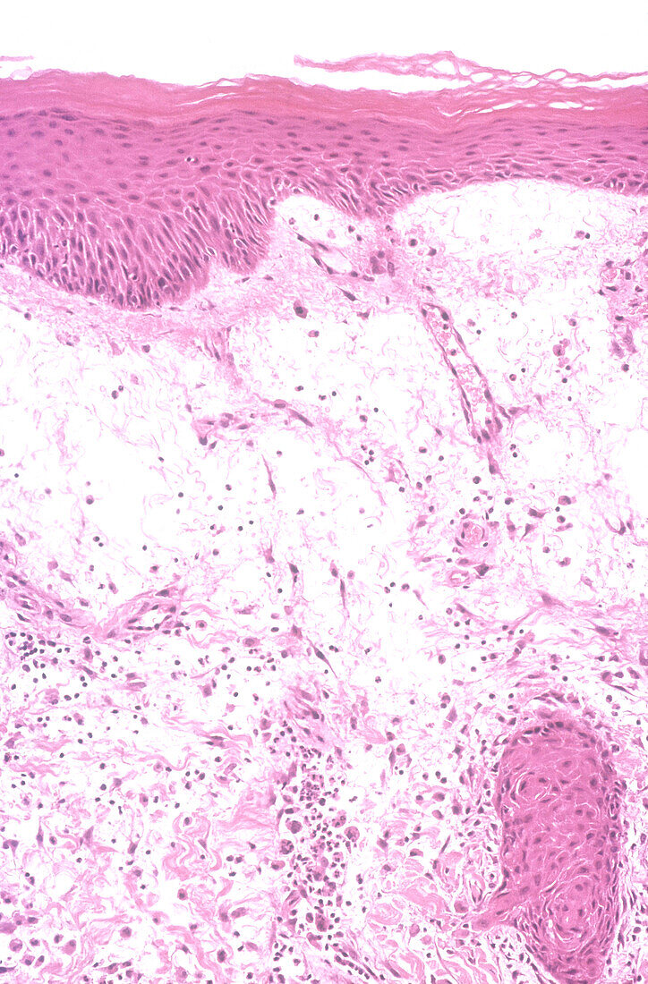 Erythema multiforme (epidermal), light micrograph