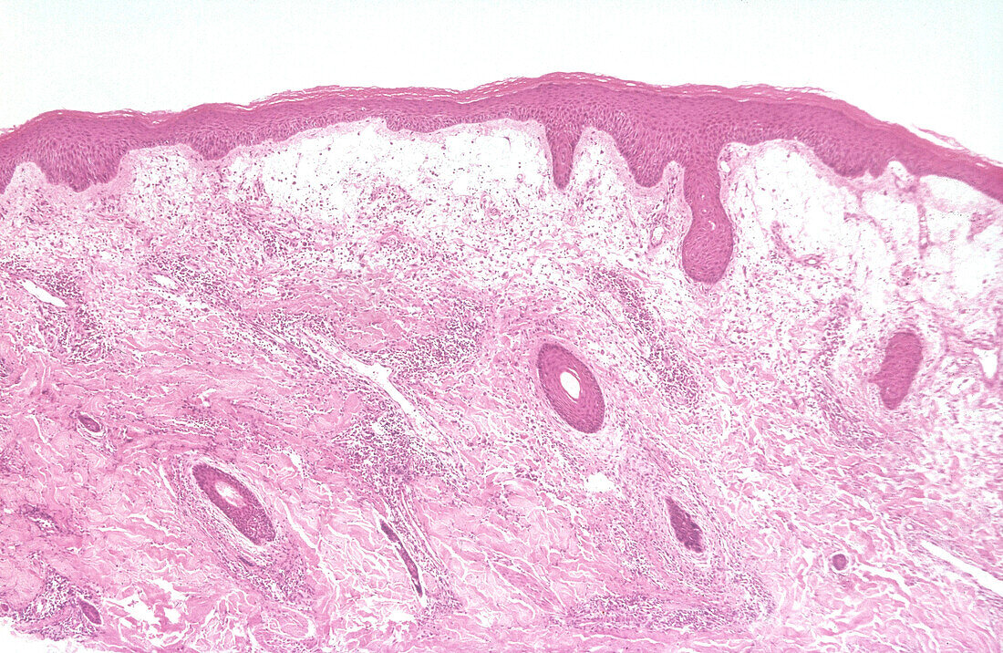 erythema multiforme (dermal), light micrograph