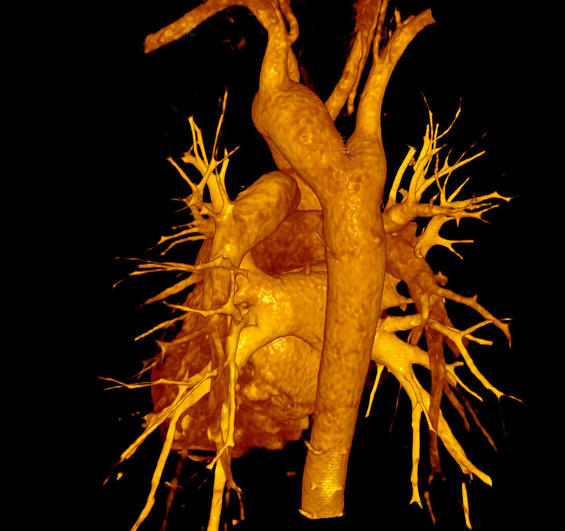 Kommerell diverticulum, 3D CT scan