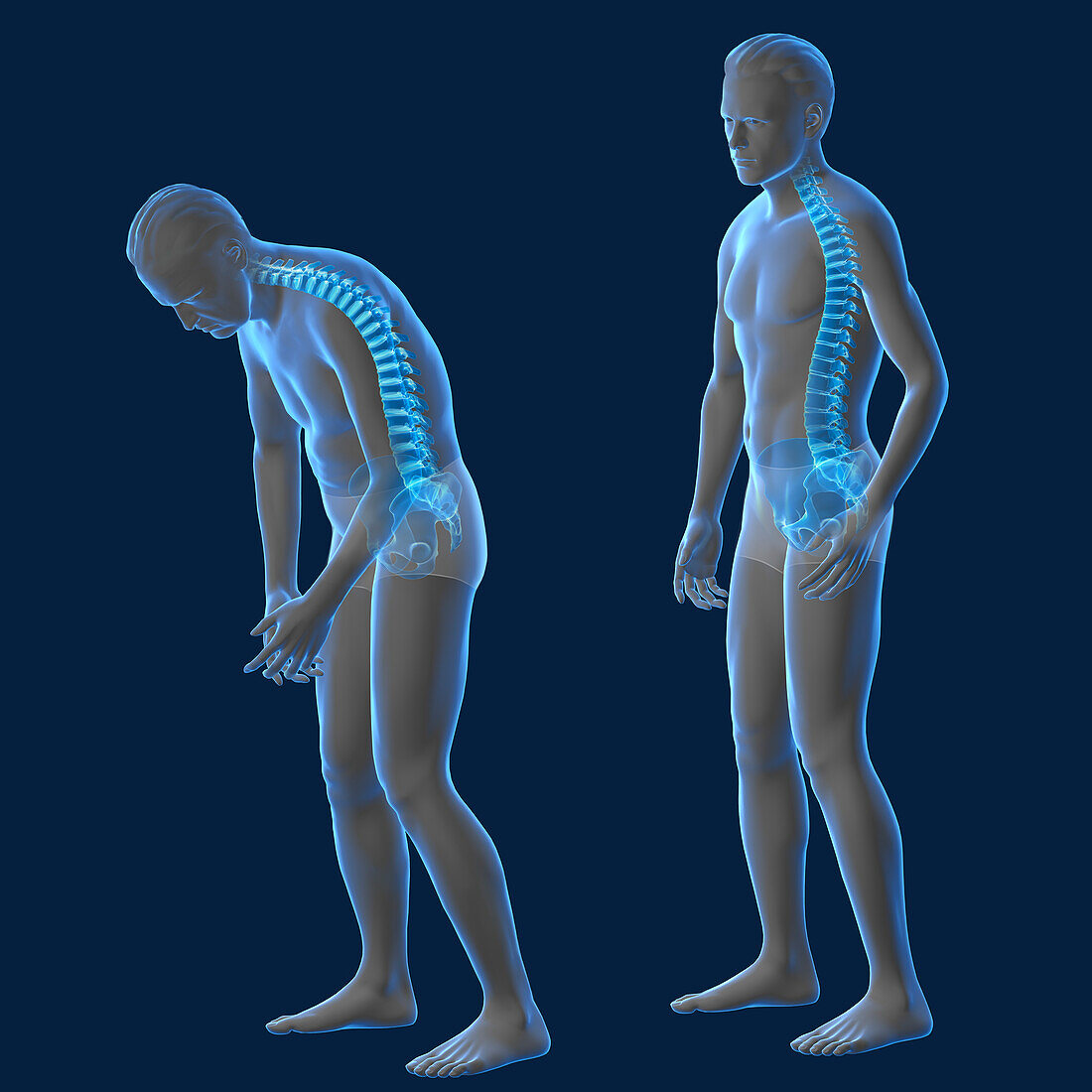 Osteoporosis, illustration