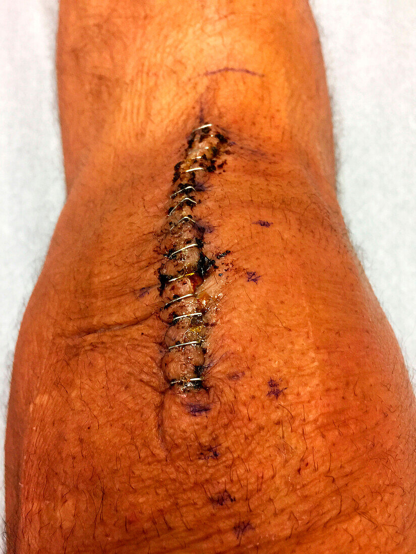 Knee with surgical staples