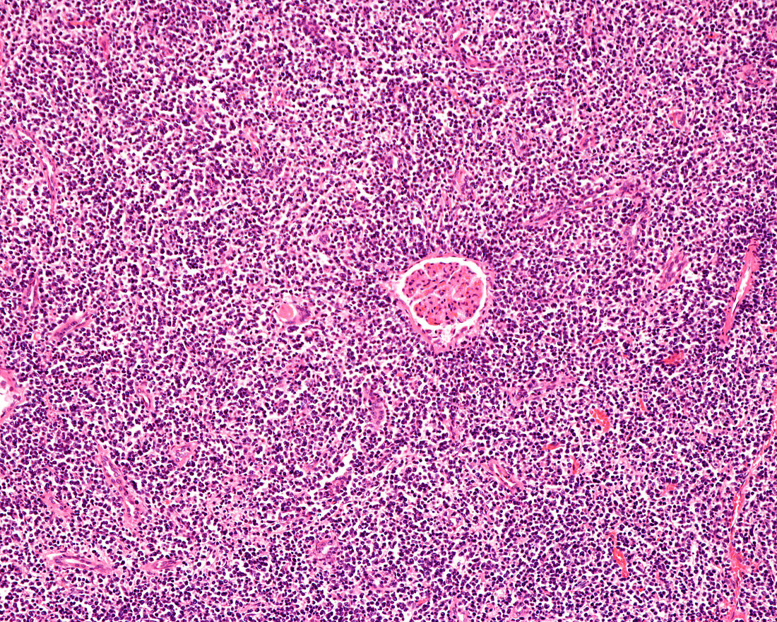 Lymphosarcoma in human kidney, light micrograph