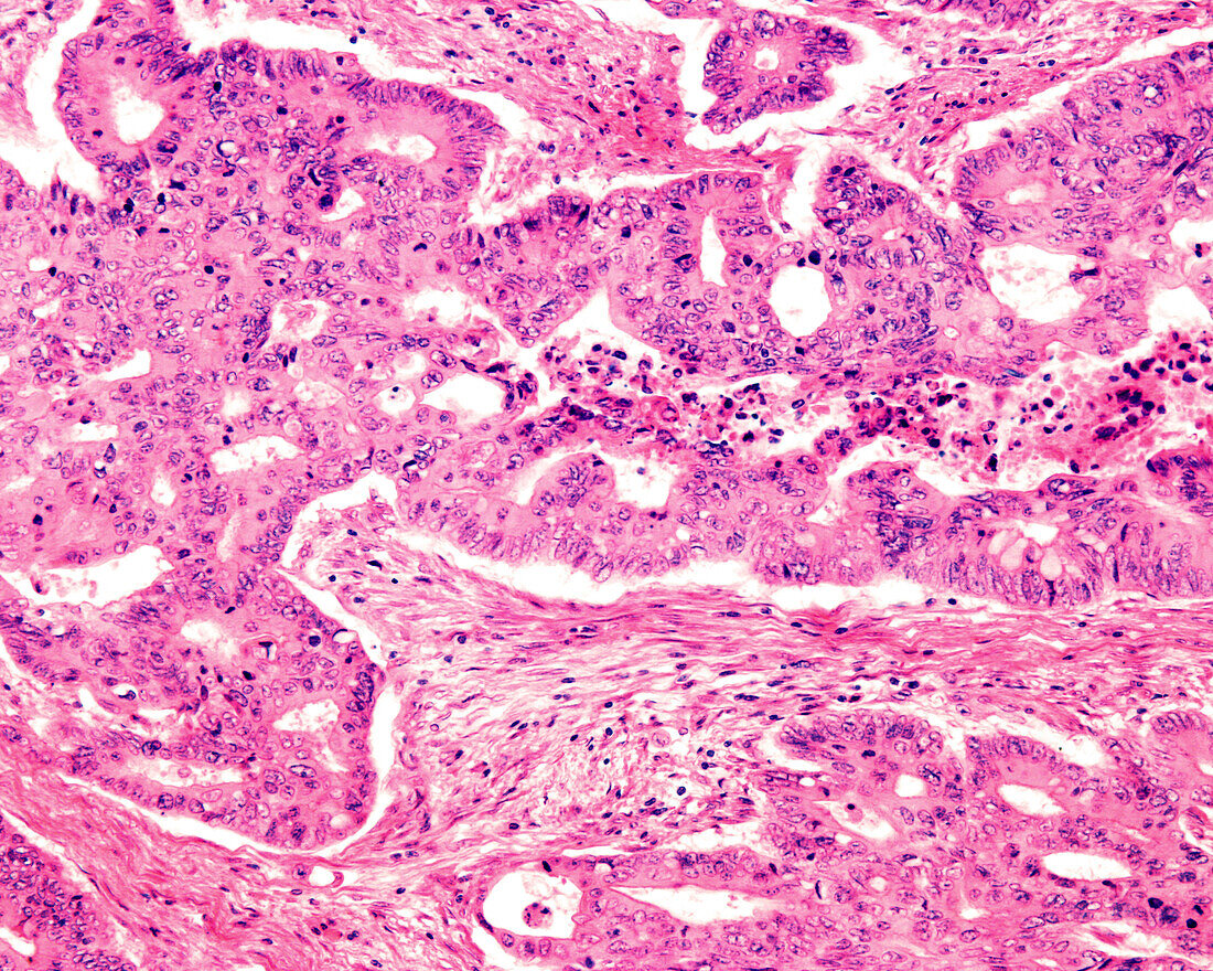 Adenocarcinoma in human colon, light micrograph