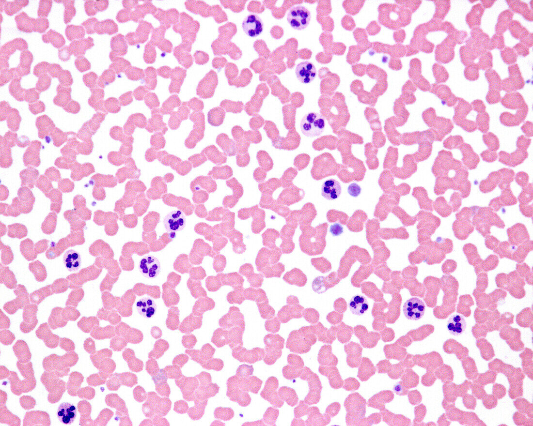 Leukocytosis, light micrograph