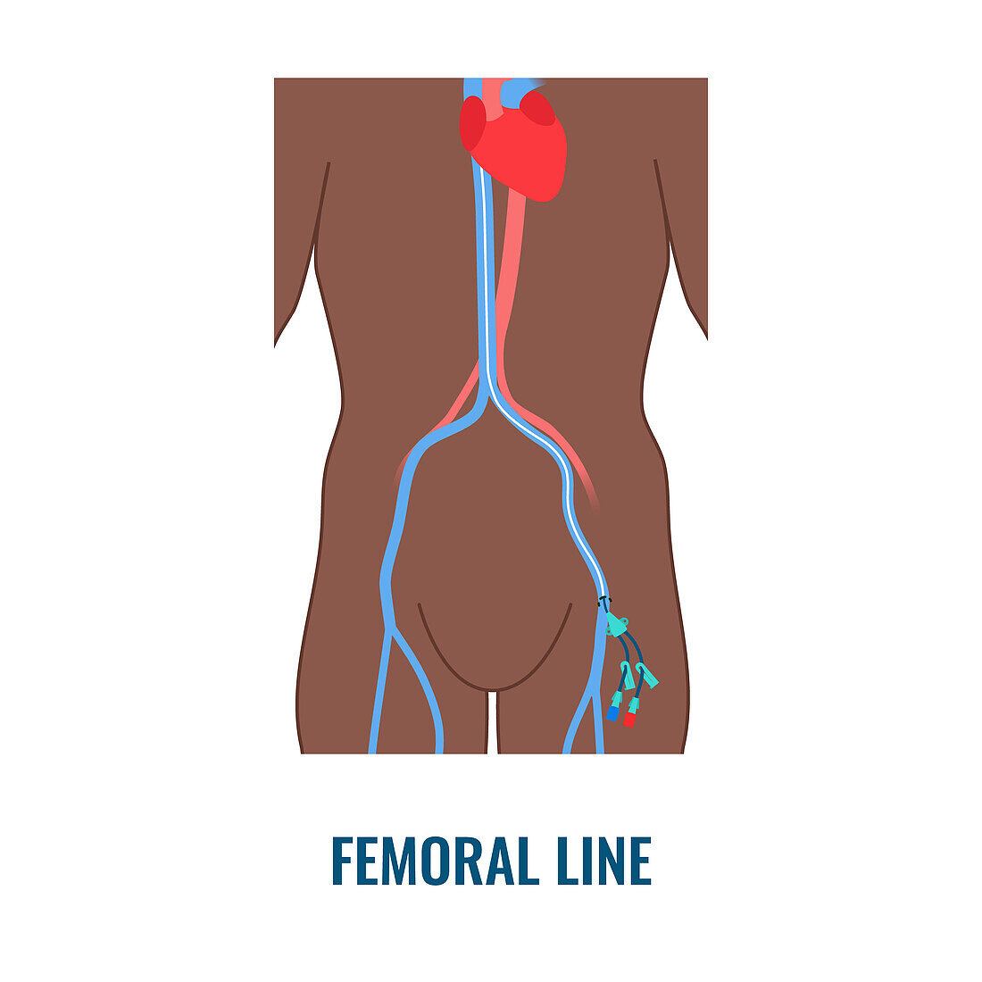 Femoral central venous catheter, illustration