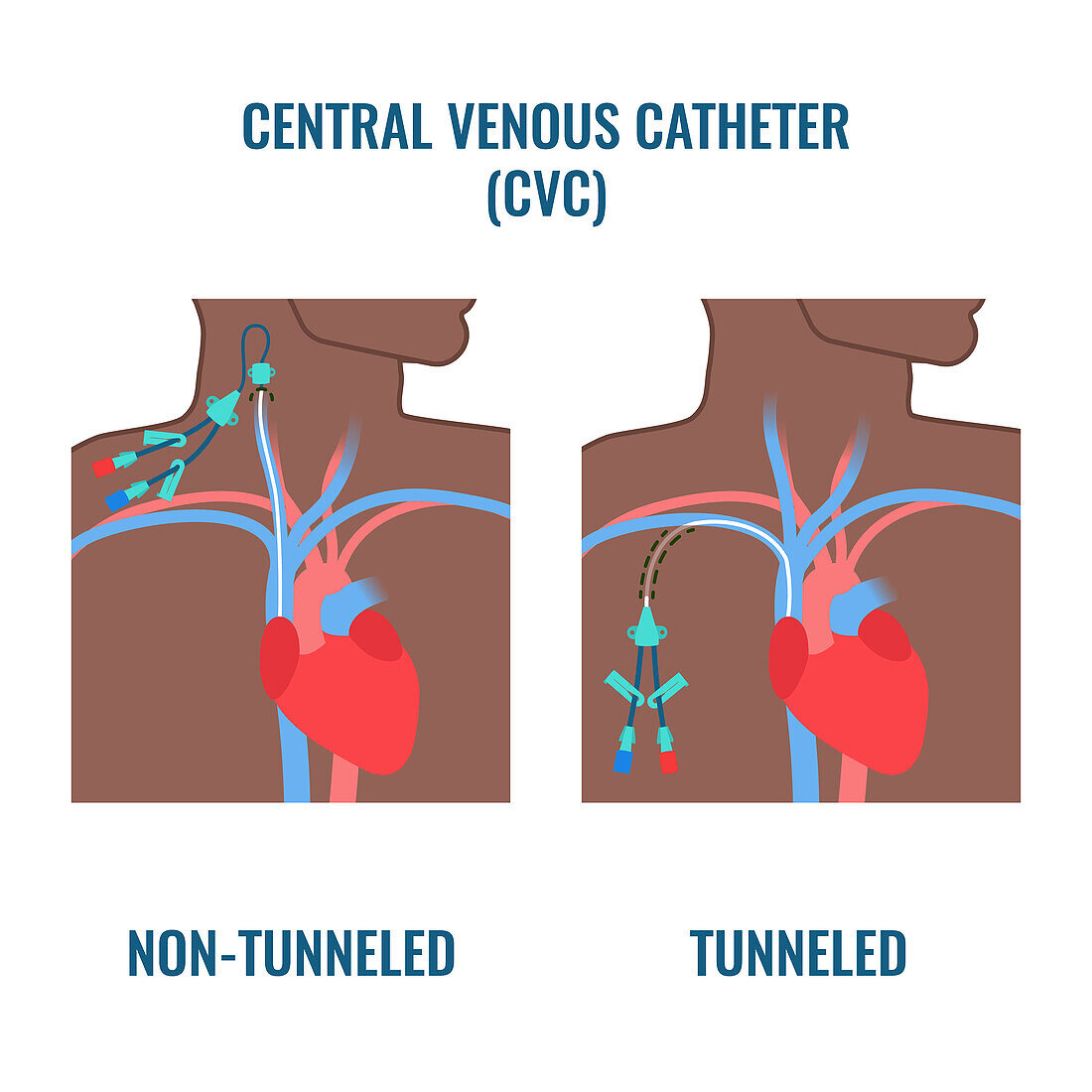 Central venous catheter, illustration