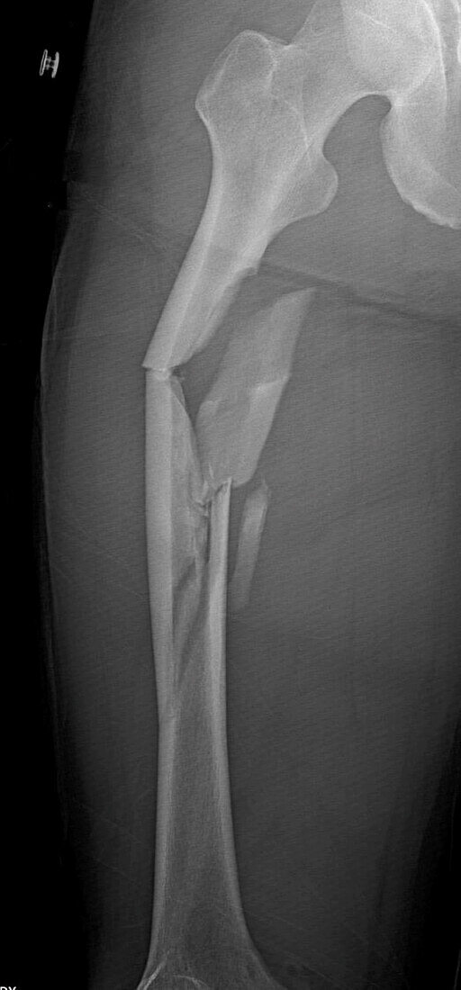 Comminuted femur fracture, X-ray