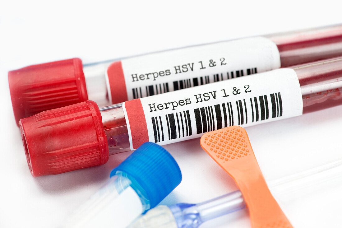 Herpes blood test tubes