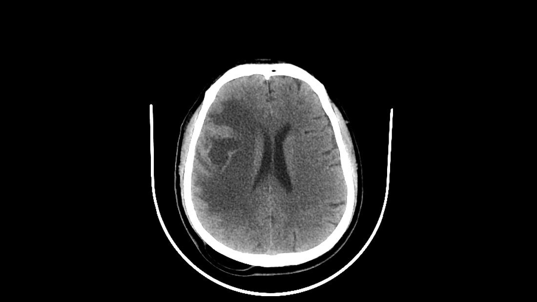 Brain metastasis, CT scan