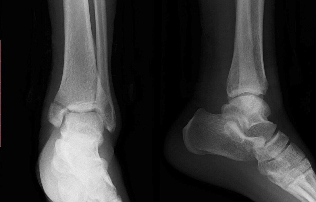 Broken ankle, X-ray
