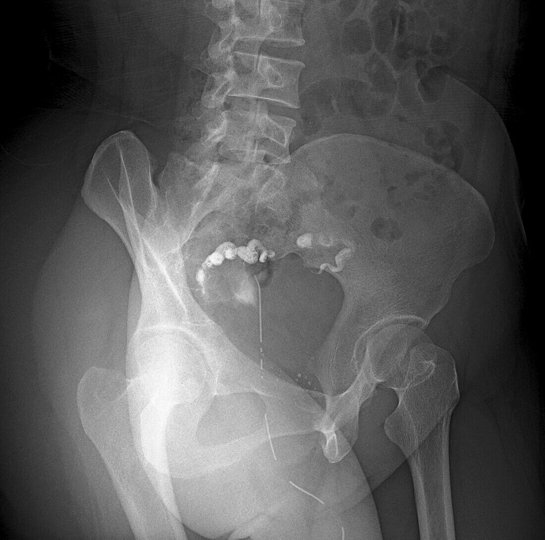 Obstructed fallopian tube, X-ray