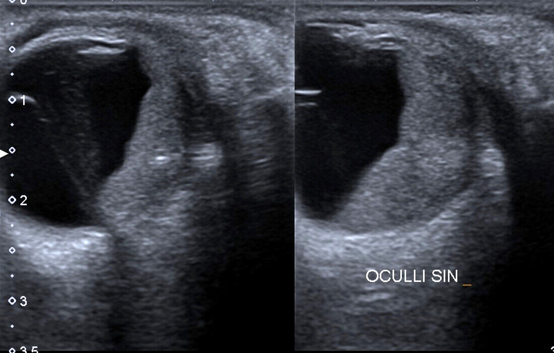 Orbital metastasis, ocular ultrasound scan