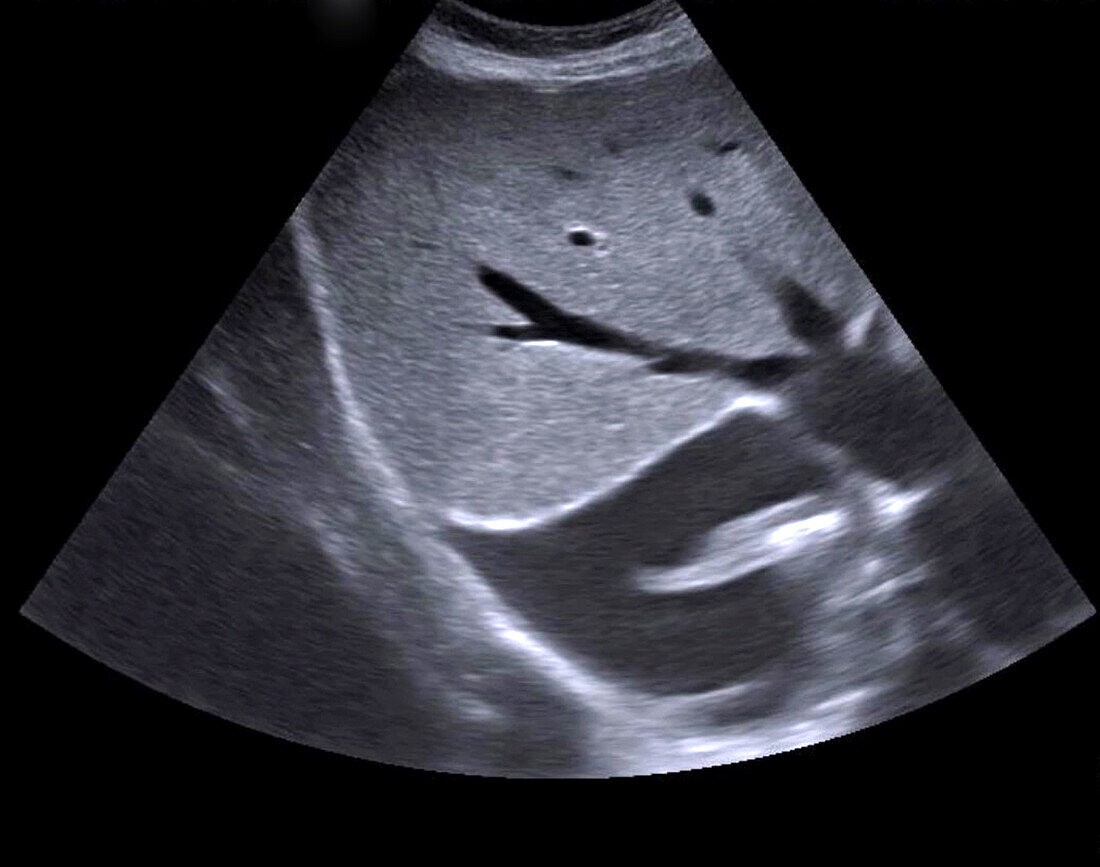 Pleural effusion, ultrasound scan