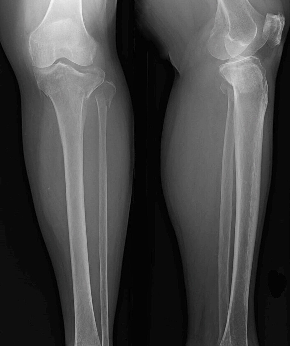 Tibial plateau fracture, X-ray