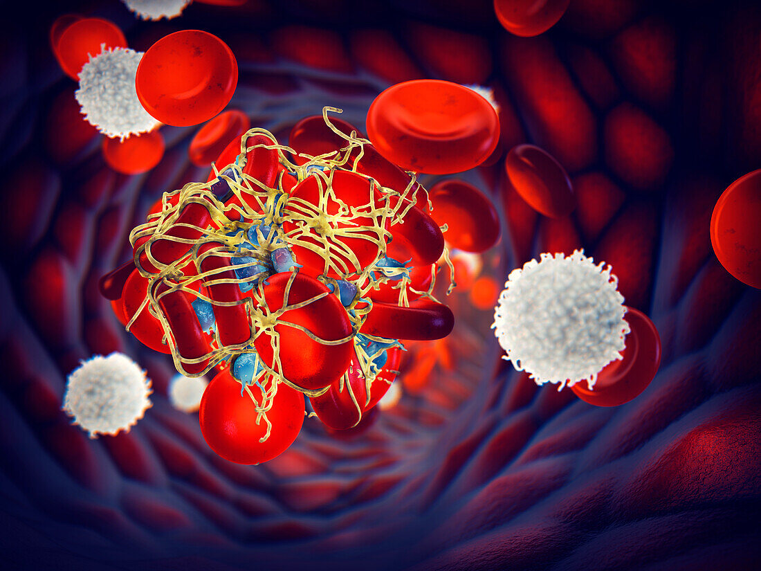 blood-clot-in-a-blood-vessel-bild-kaufen-13624097-science-photo