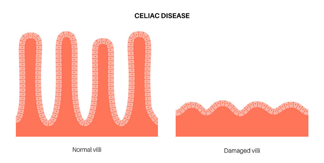 Celiac disease inflammation, illustration