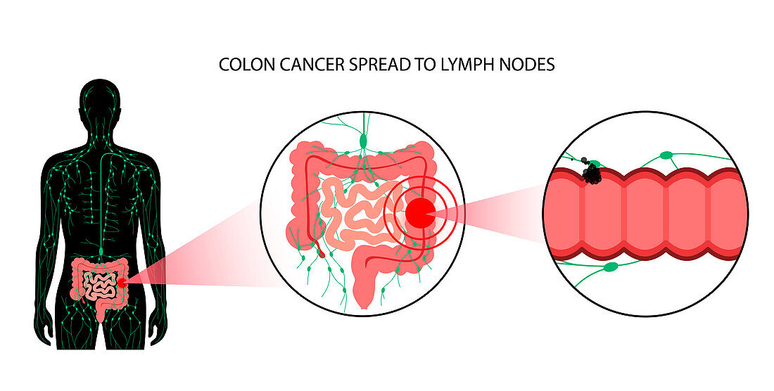 Colon cancer stages, illustration