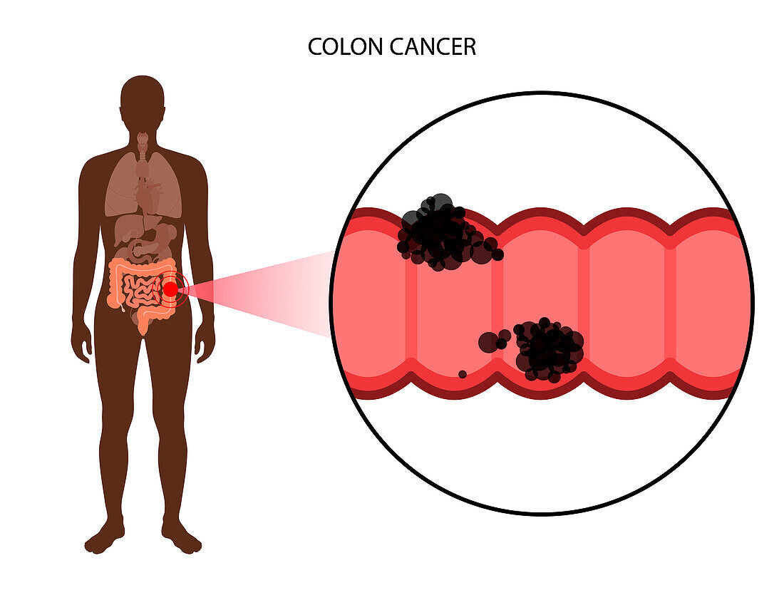 Colon cancer stages, illustration