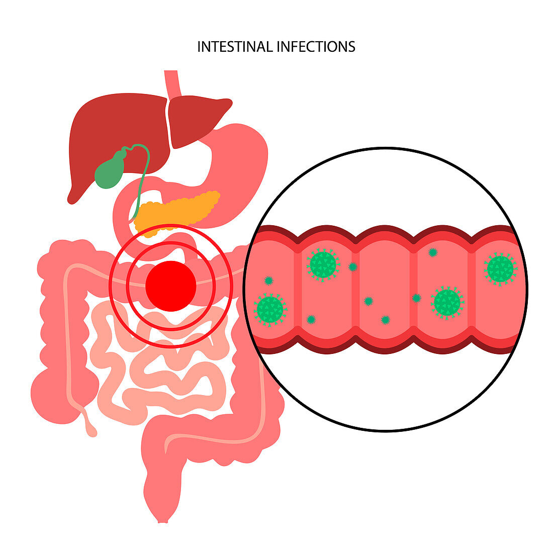 Intestinal infection, illustration