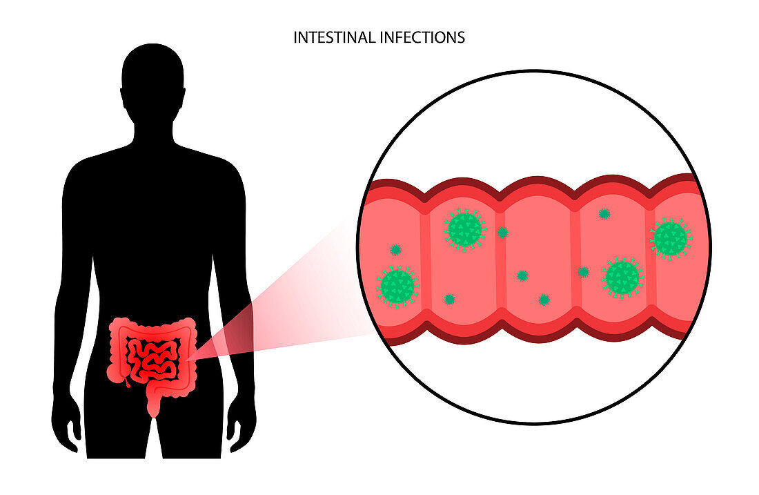 Intestinal infection, illustration
