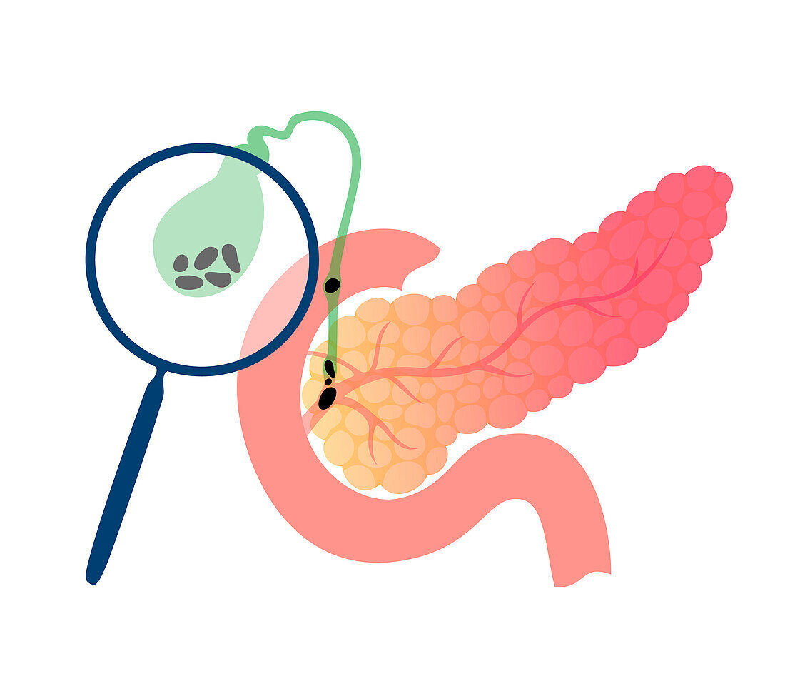 Pancreatic disease, conceptual illustration