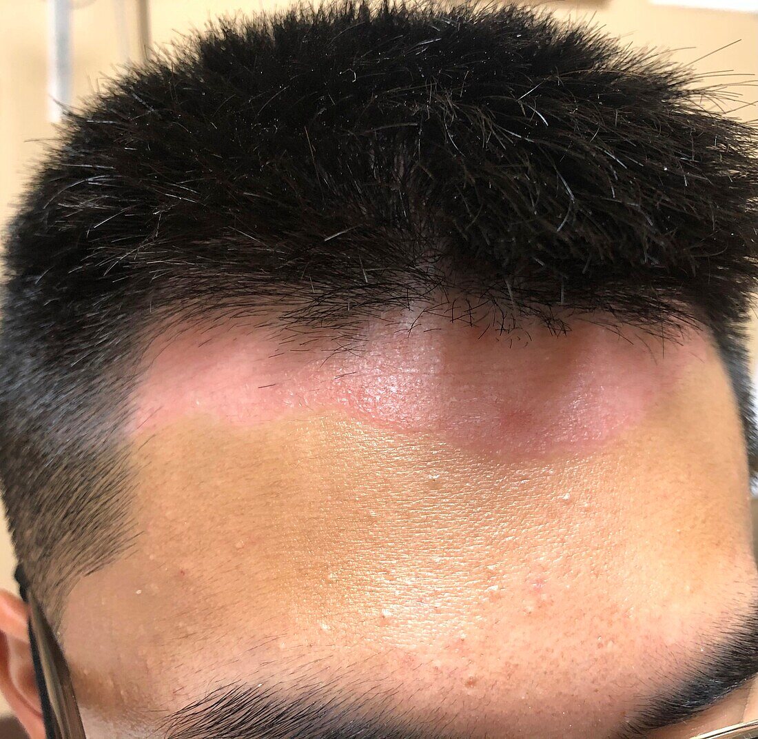 Psoriasis of scalp