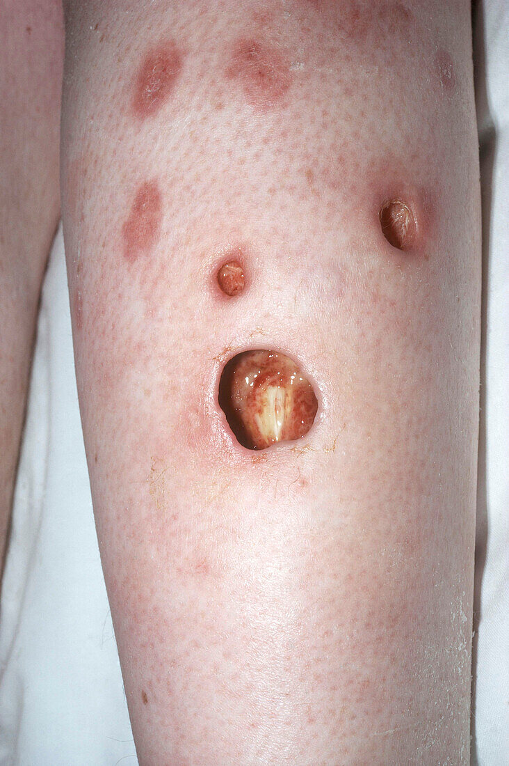 Ulcerative colitis in leg