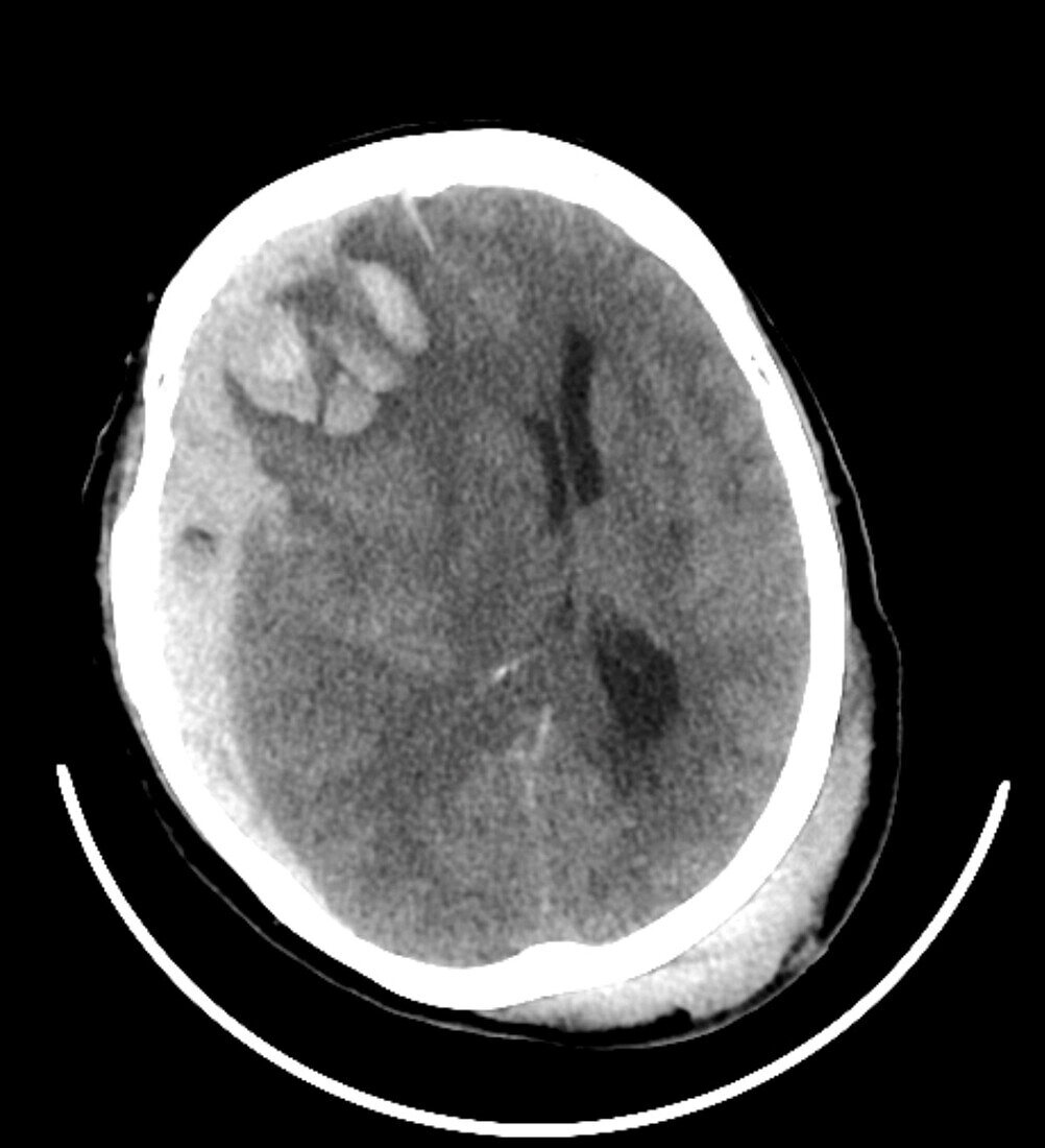 Traumatic brain injuries, CT scan