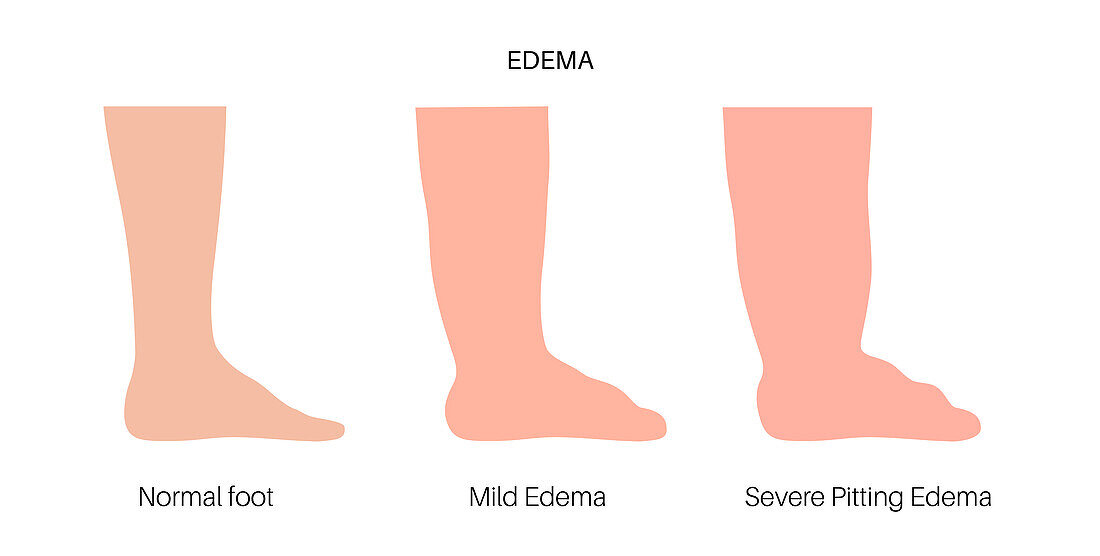 Oedema of feet , illustration