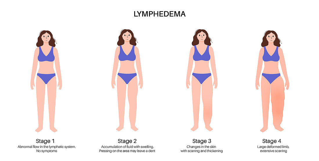 Stages of lymphoedema, illustration
