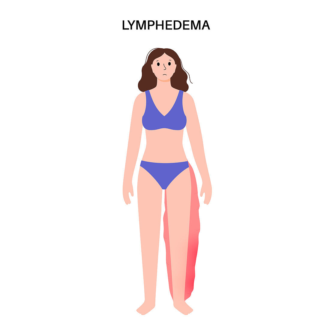 Lymphoedema leg swelling, illustration