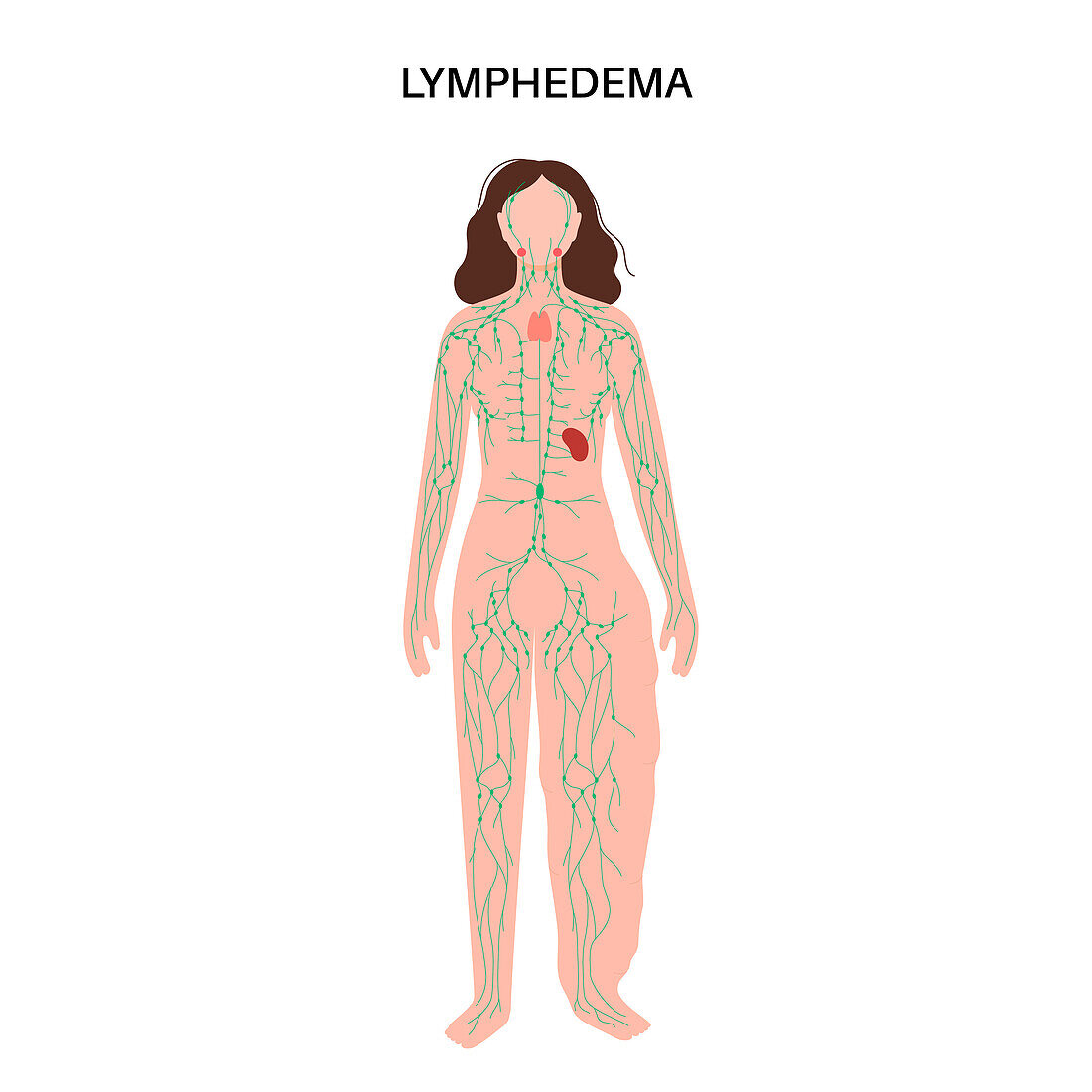Lymphoedema leg swelling, illustration