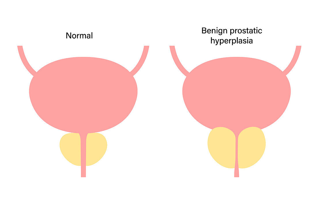 Benign prostatic hyperplasia, illustration
