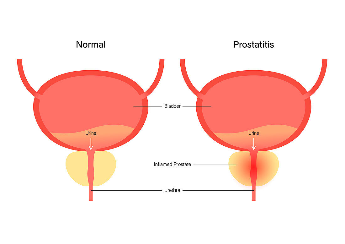 Prostatitis, illustration