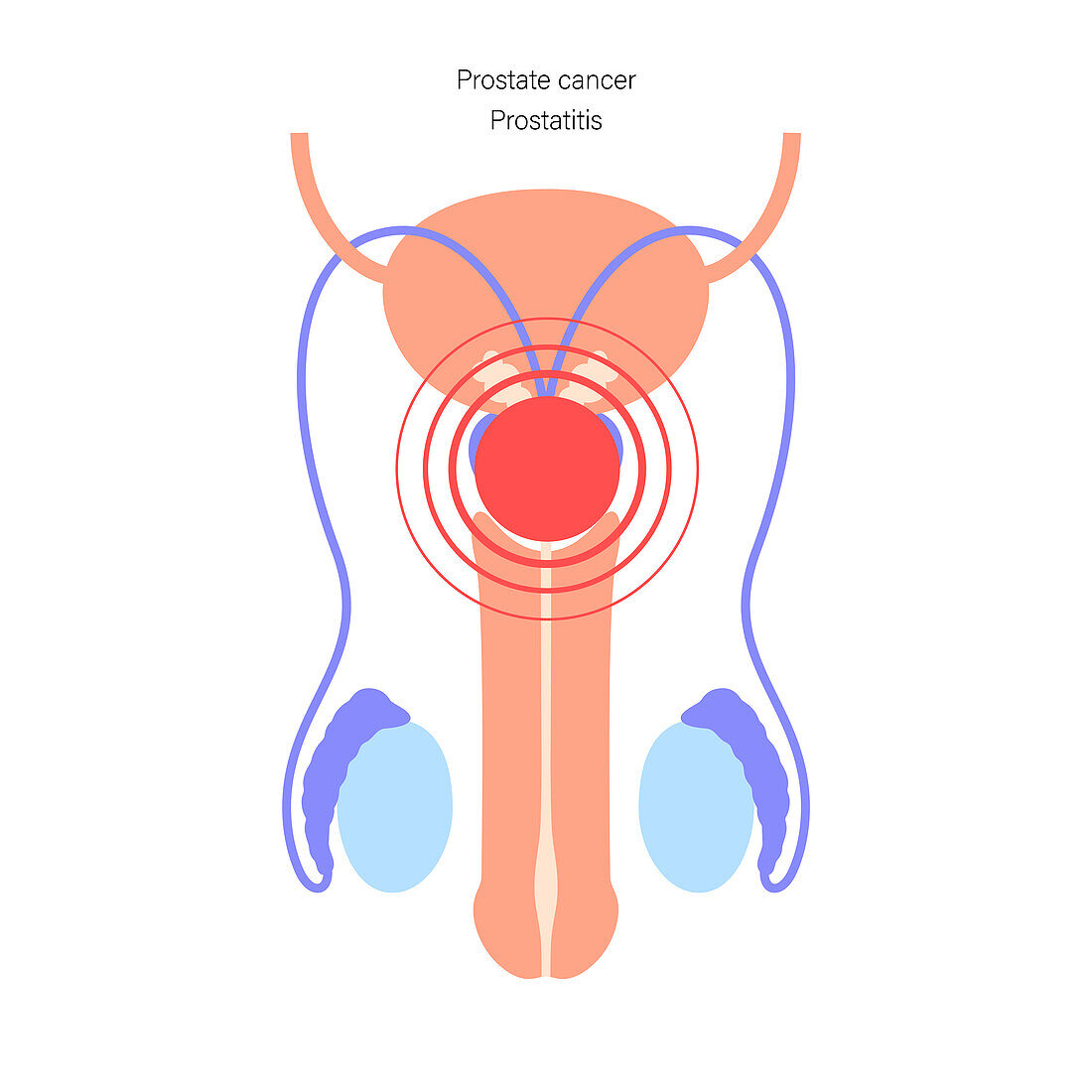 Prostate disease, illustration