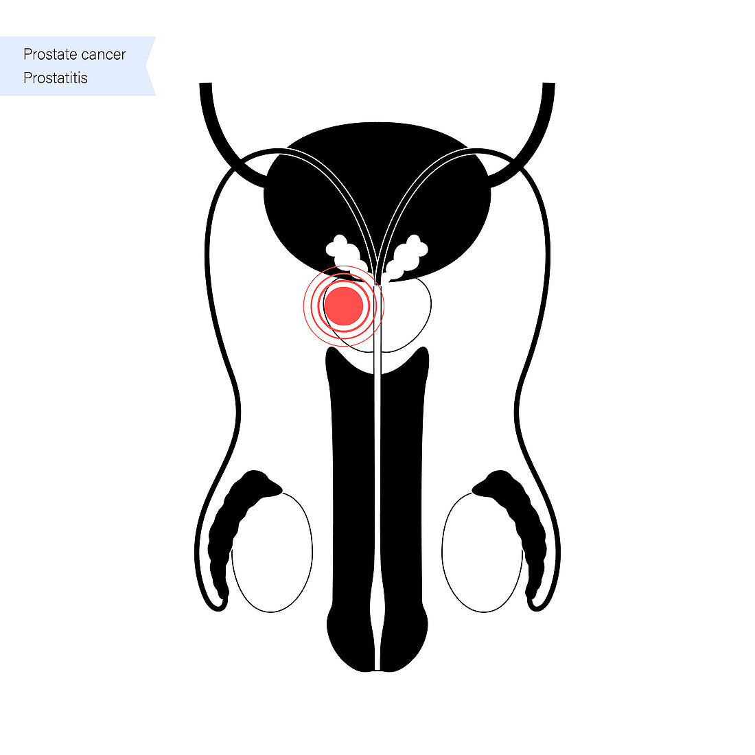 Prostate disease, illustration