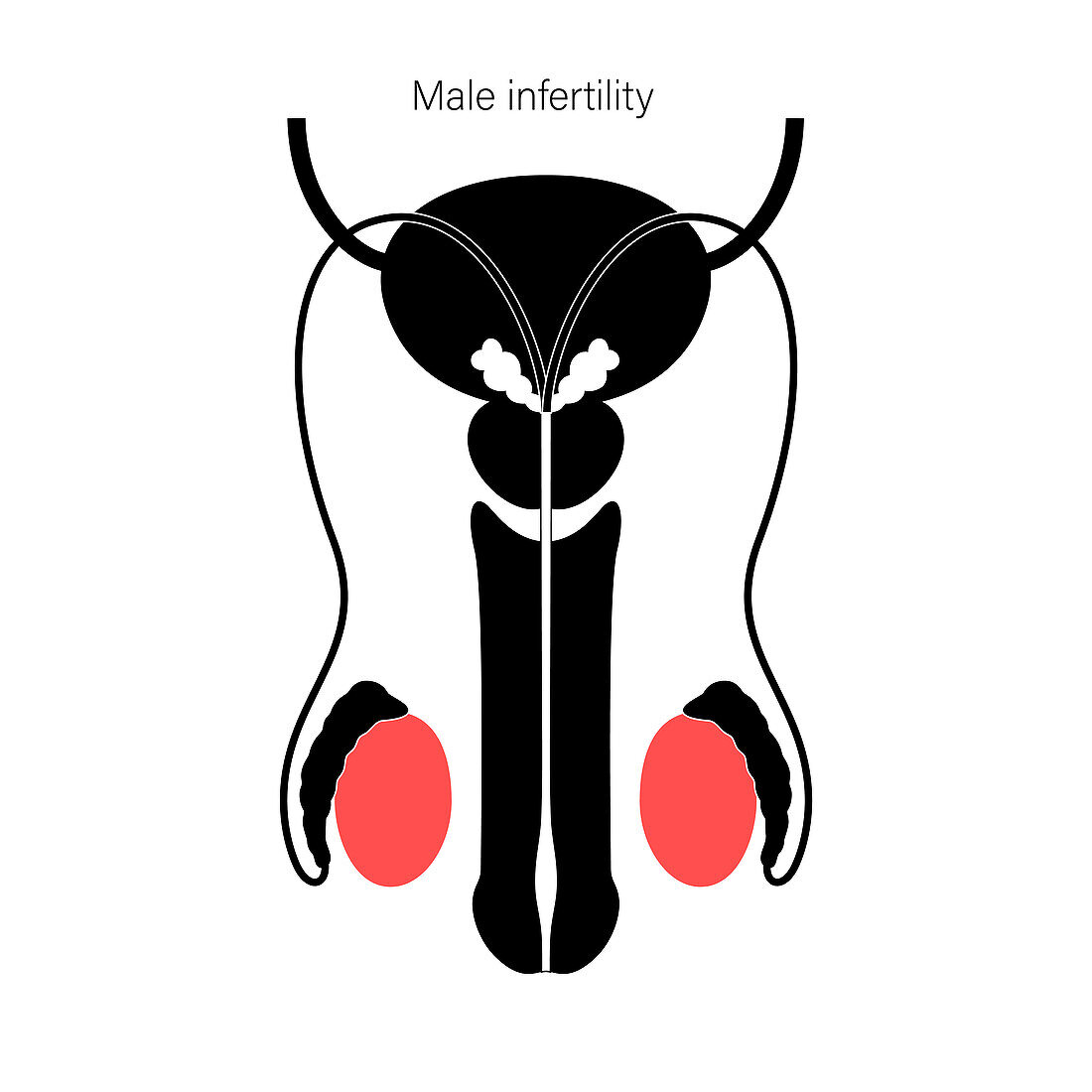 Male infertility, illustration