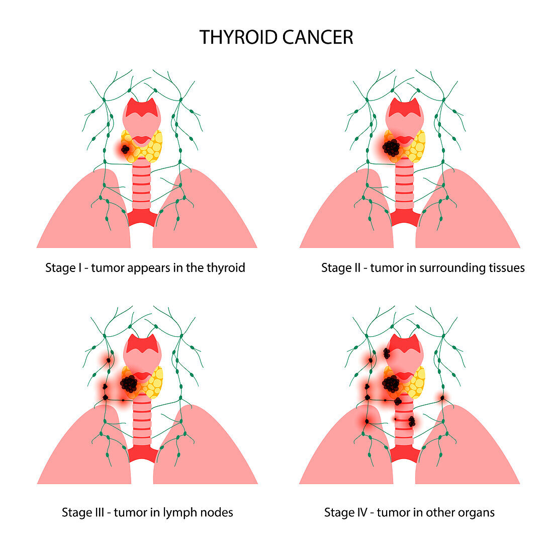 Thyroid cancer stages, illustration