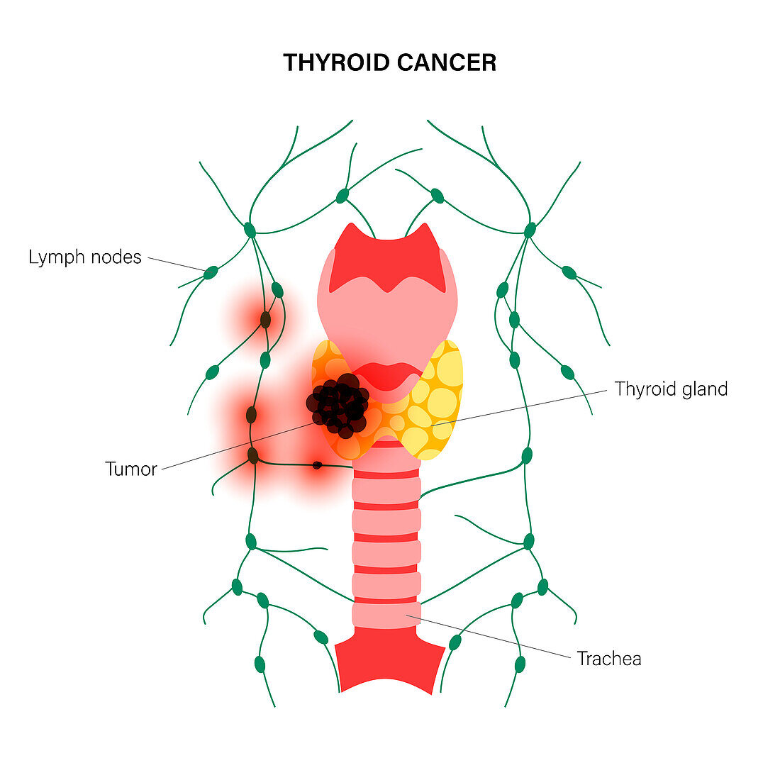 Thyroid cancer, illustration