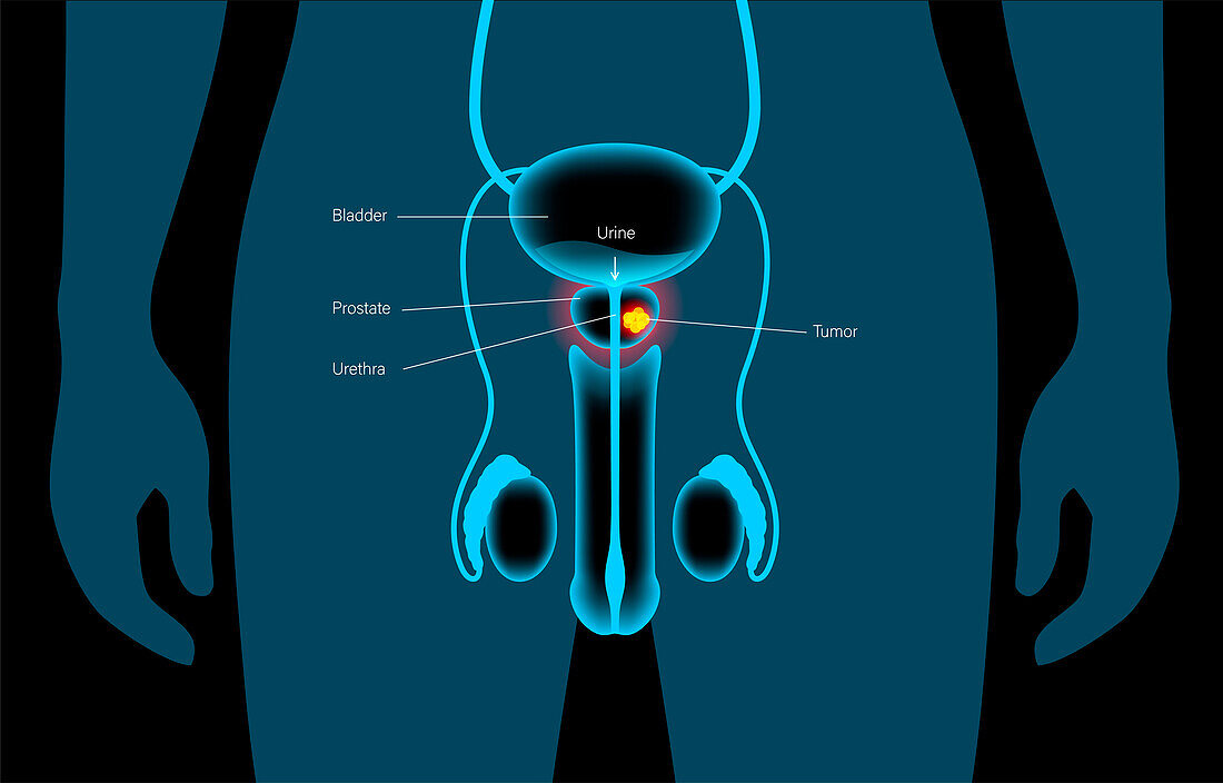 Prostate cancer, illustration