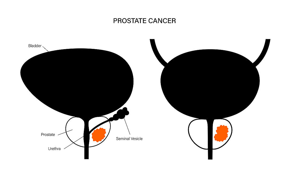 Prostate cancer, illustration