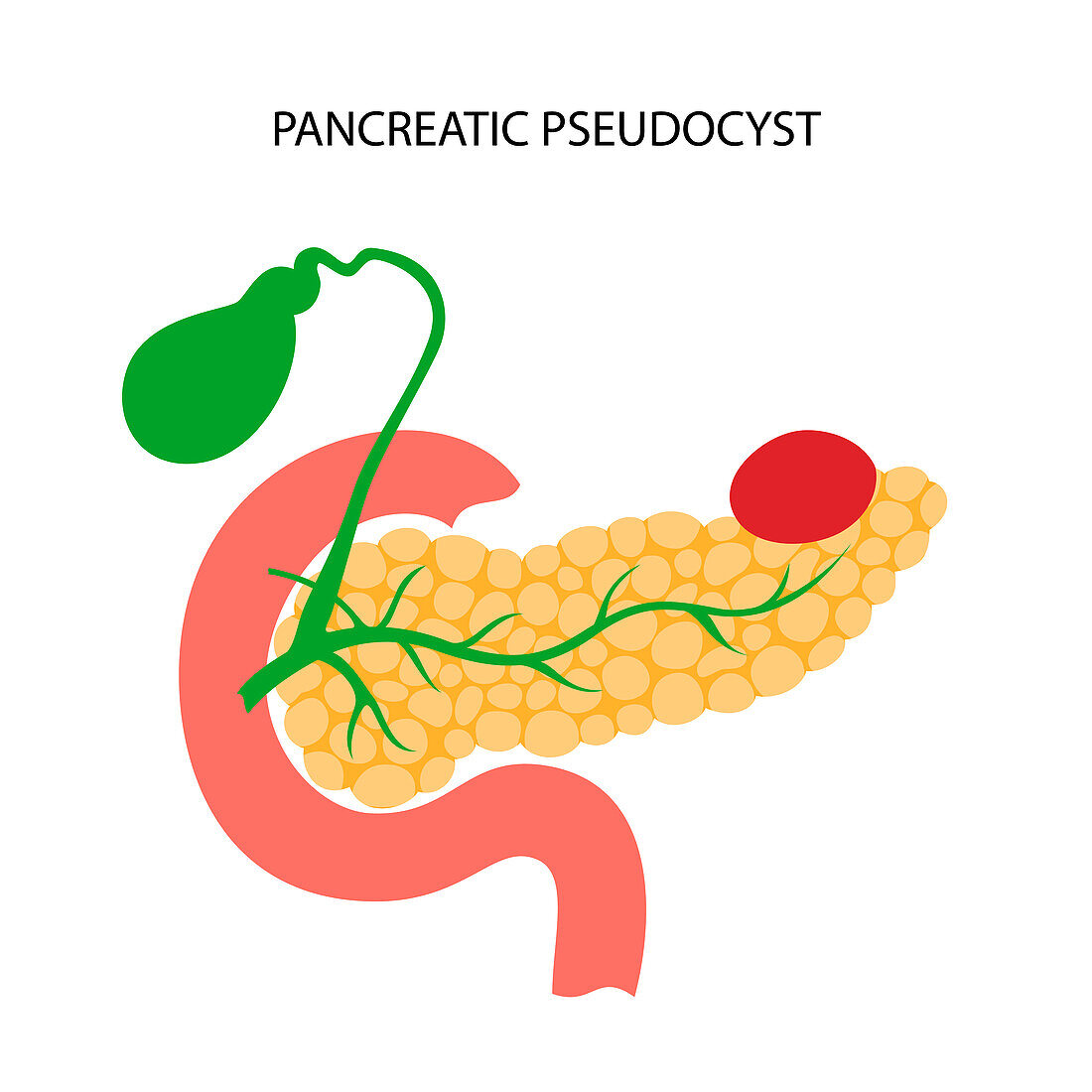 Pancreatic pseudocyst, illustration